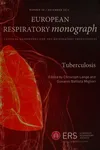 Tuberculosis