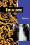 Tuberculosis