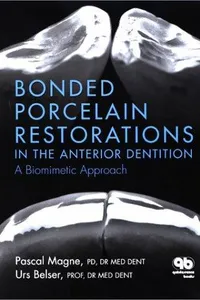 Bonded porcelain restorations in the anterior dentition