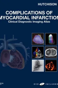 Complications of myocardial infarction