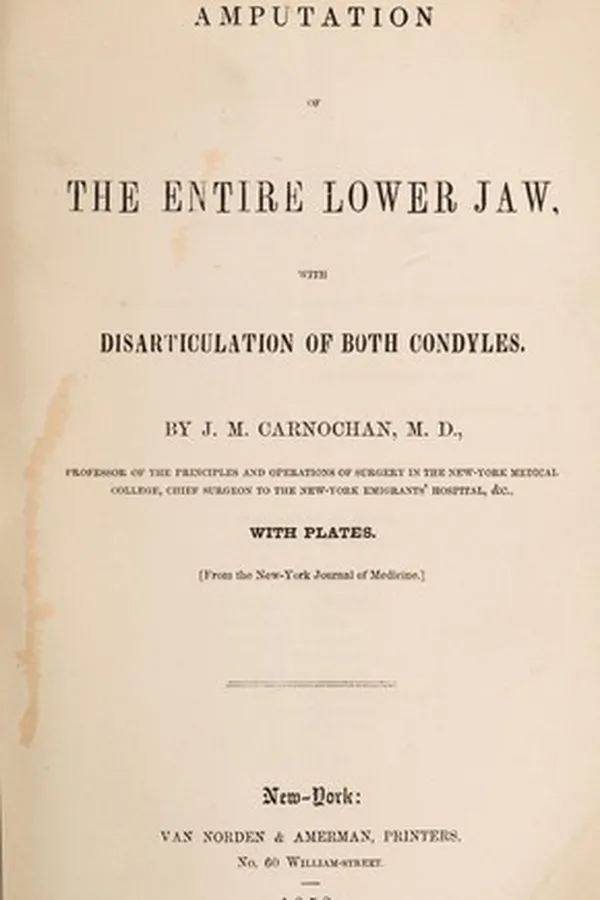 Capa de Amputation of the entire lower jaw, with disarticulation of both condyles